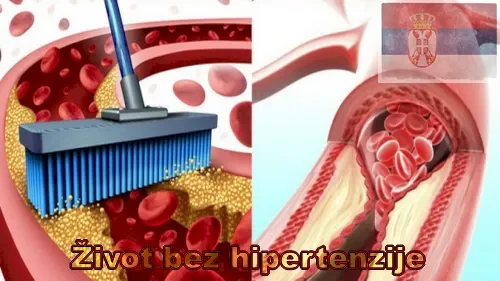 Arterijska hipertenzija.